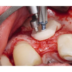 kit de fijación osea, incluye tornillo de acero 1 mm.