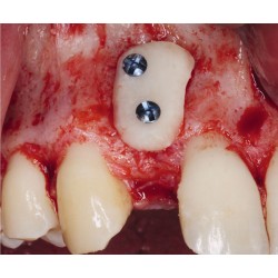 kit de fijación osea, incluye tornillo de acero 1 mm.