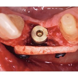 kit de fijación osea, incluye tornillo de acero 1 mm.