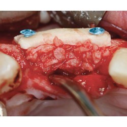 kit de fijación osea, incluye tornillo de acero 1 mm.