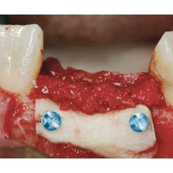 kit de fijación osea, incluye tornillo de acero 1 mm.