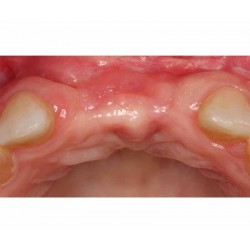 SCHLEE, kit para realizar aumento oseo con técnica de paraguas