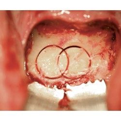 Ustomed NENTWIG, Retractor  especial dentado, 14 mm,