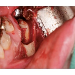 Ustomed NENTWIG, Retractor especial dentado, 70X 14 mm,