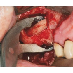 Ustomed NENTWIG Forceps para fijación osea