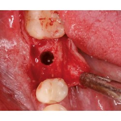 Ustomed NENTWIG, expansores de hueso, tamaño 1, recto
