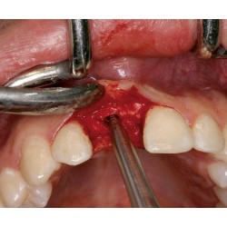 Ustomed NENTWIG, expansores de hueso, talla 2, recto