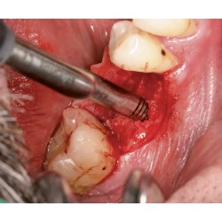 Ustomed NENTWIG, expansores de hueso, talla 4, recto