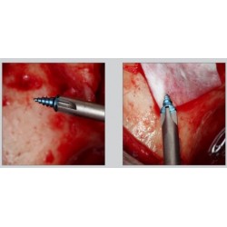 Ustomed Tornillo de membrana Ø 1, 5 x 4 mm, autoperforante, titanio 10 uds.