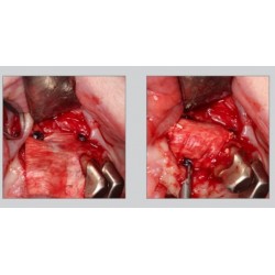 Ustomed Tornillo de membrana Ø 1, 5 x 4 mm, autoperforante, titanio 10 uds.